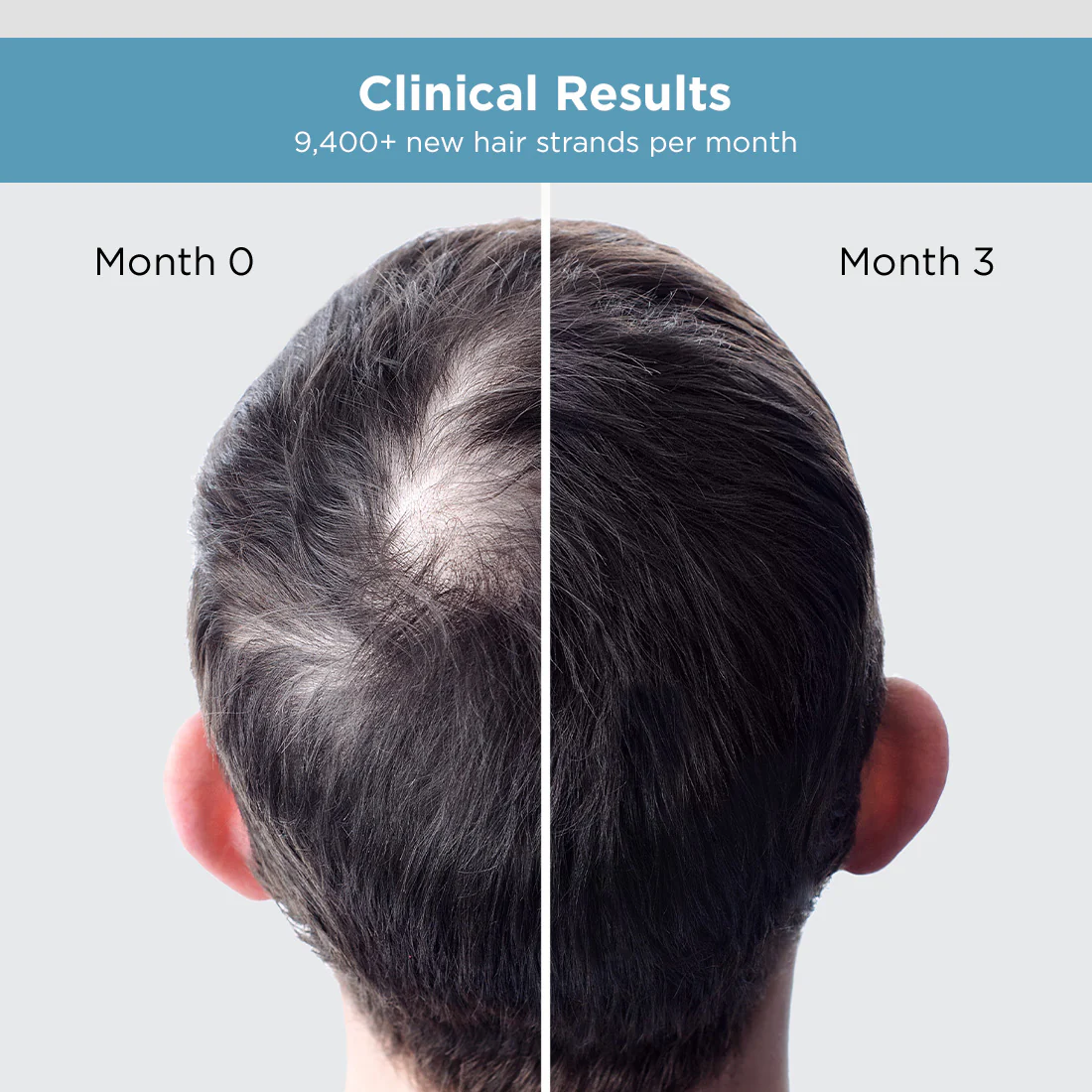 Hair Growth Serum | Visible Result in 3 Months (30ml) - Image 18