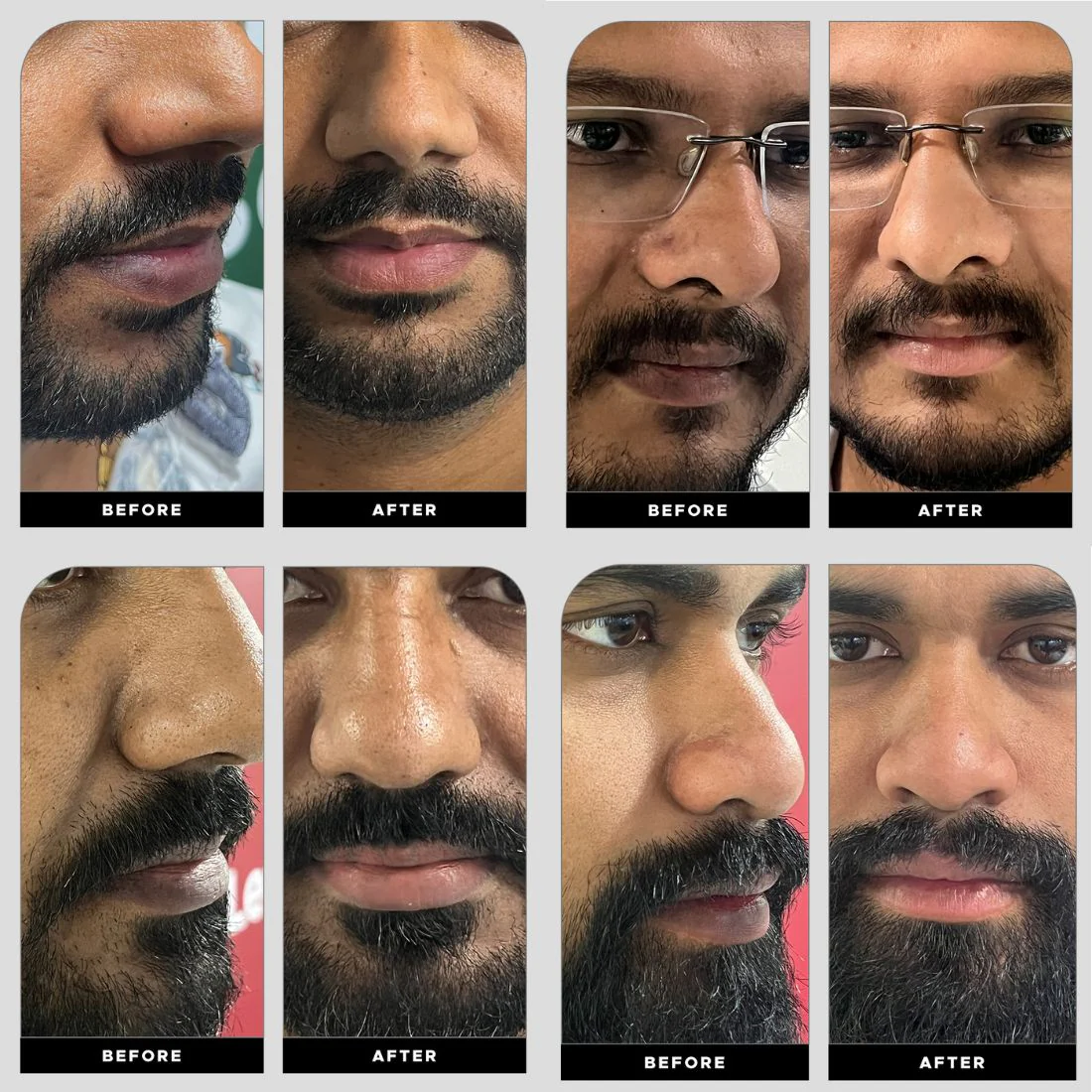 Lip Lightening Regime - Image 4